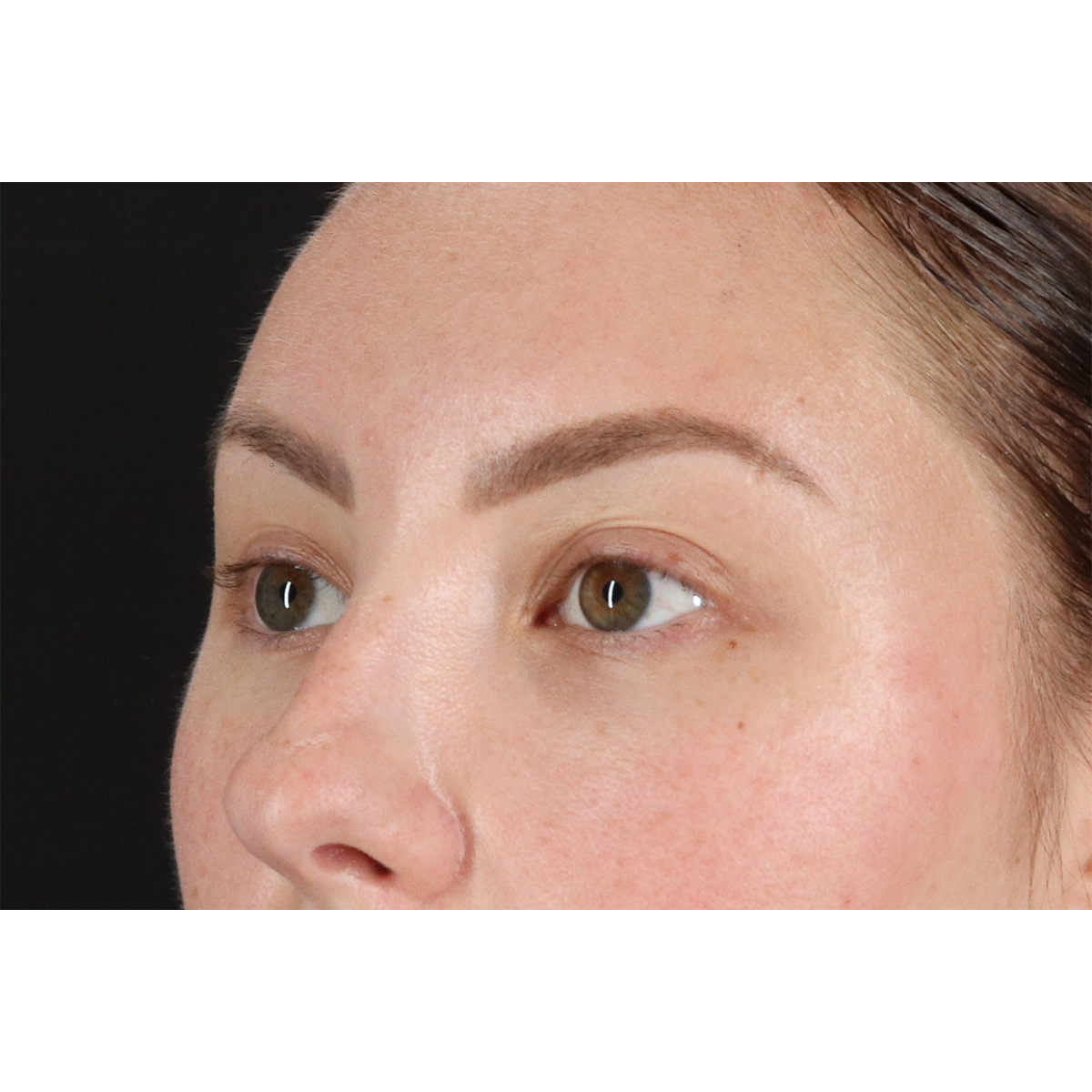 Brow Lift Before & After Patient #3111