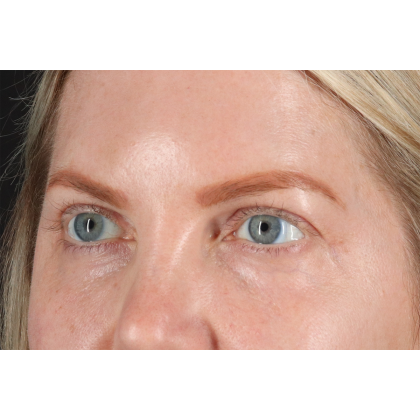 Eyelid Surgery Before & After Patient #3112