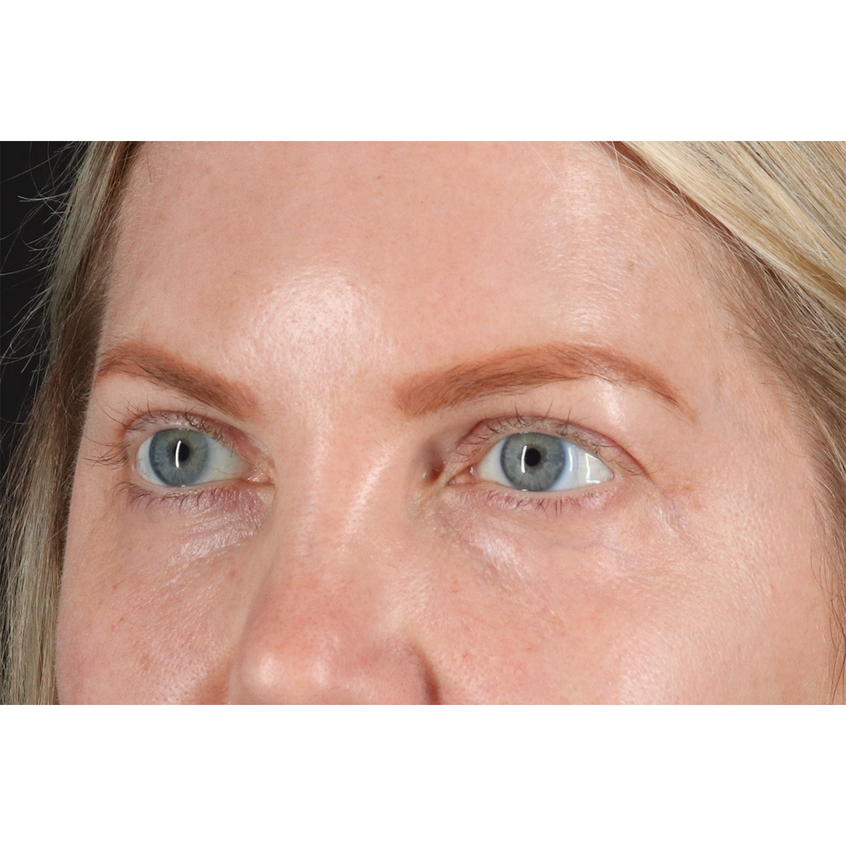 Eyelid Surgery Before & After Patient #3112