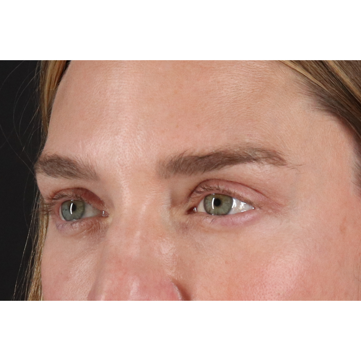 Eyelid Surgery Before & After Patient #3571