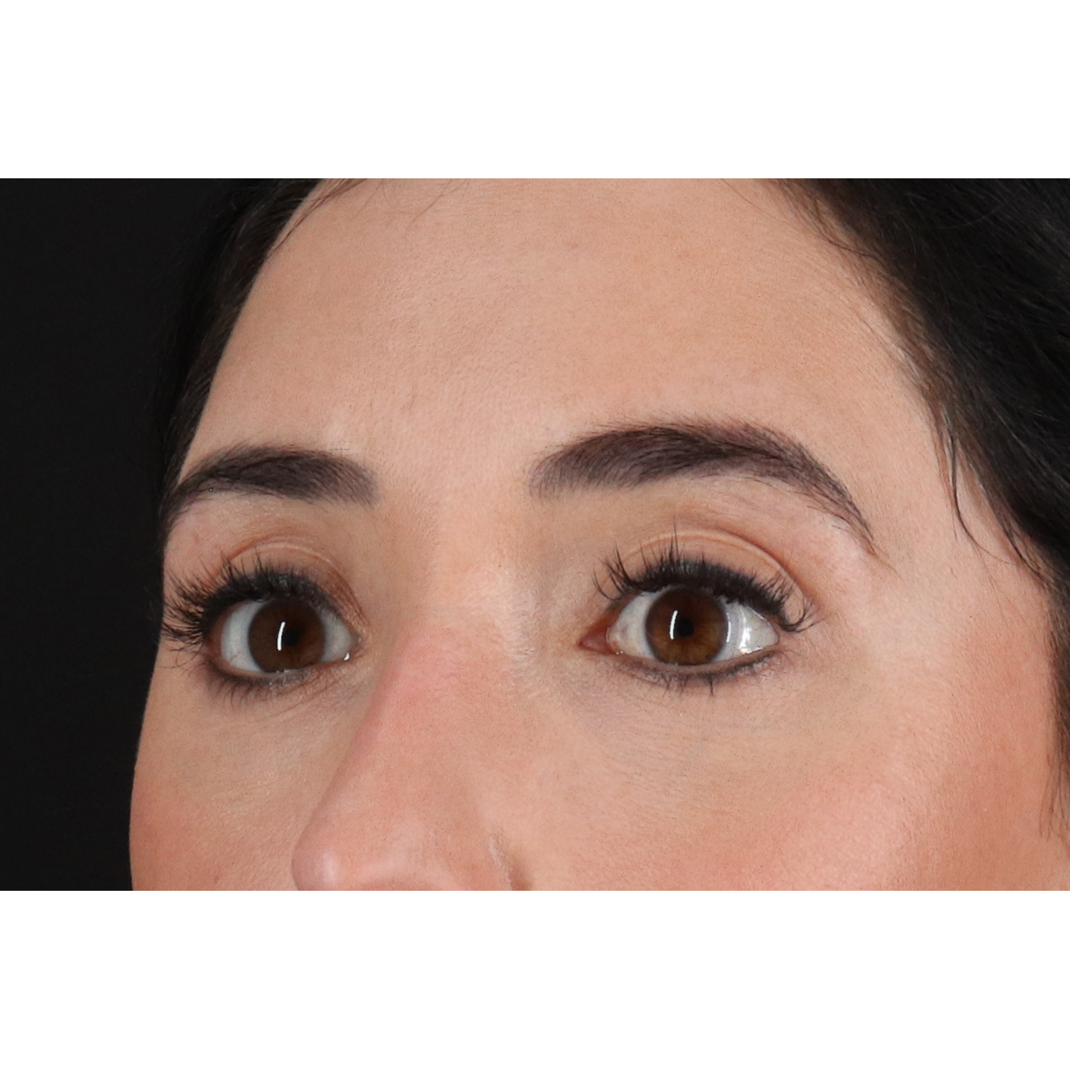 Eyelid Surgery Before & After Patient #3358