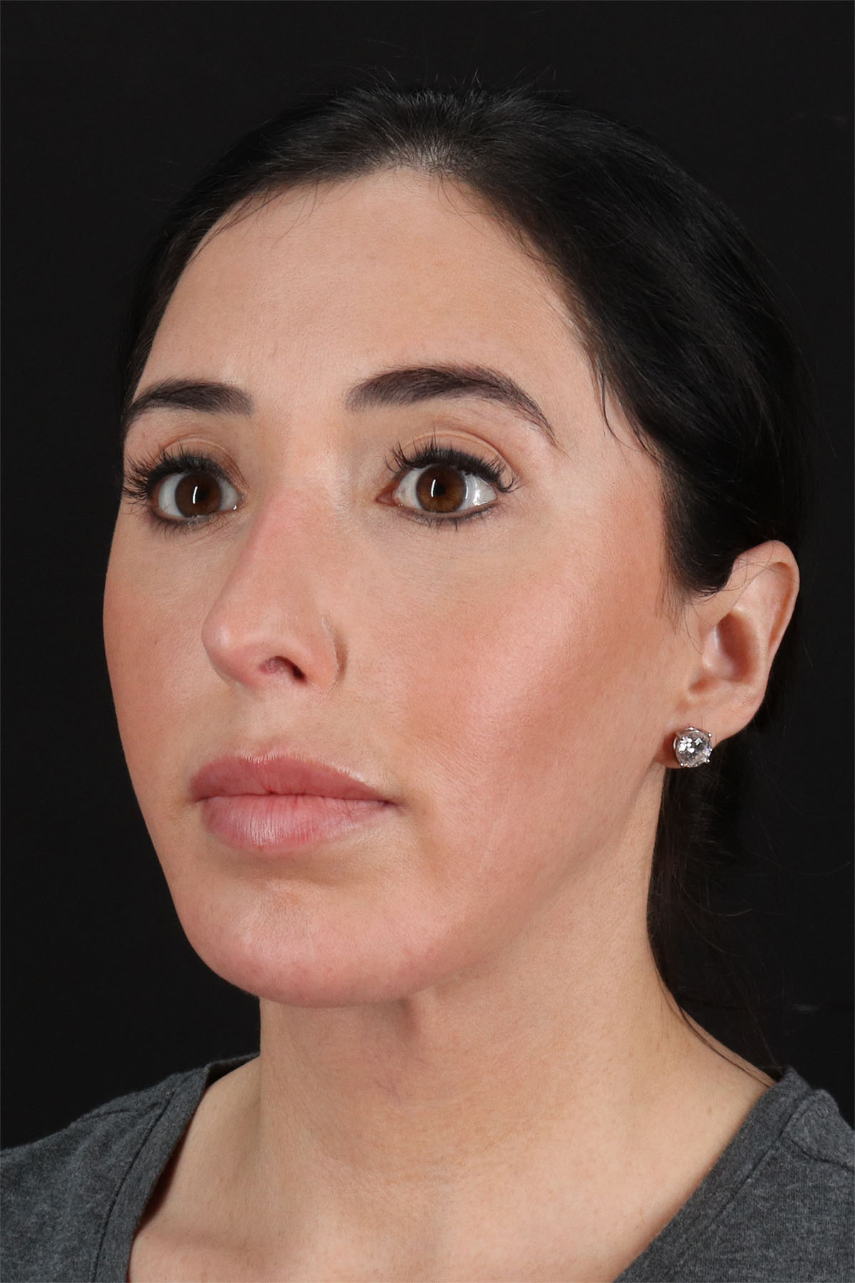 Structural Fat Grafting Before & After Patient #3649