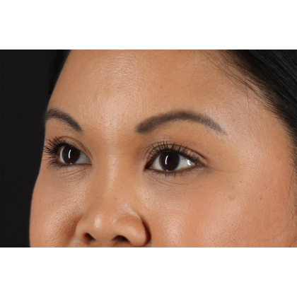 Brow Lift Before & After Patient #3114
