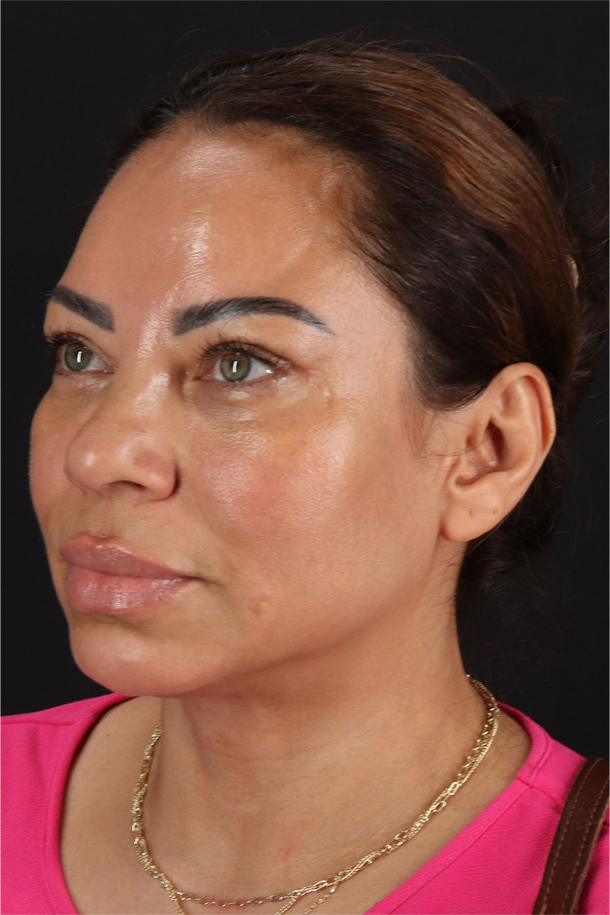 Laser Before & After Patient #3359