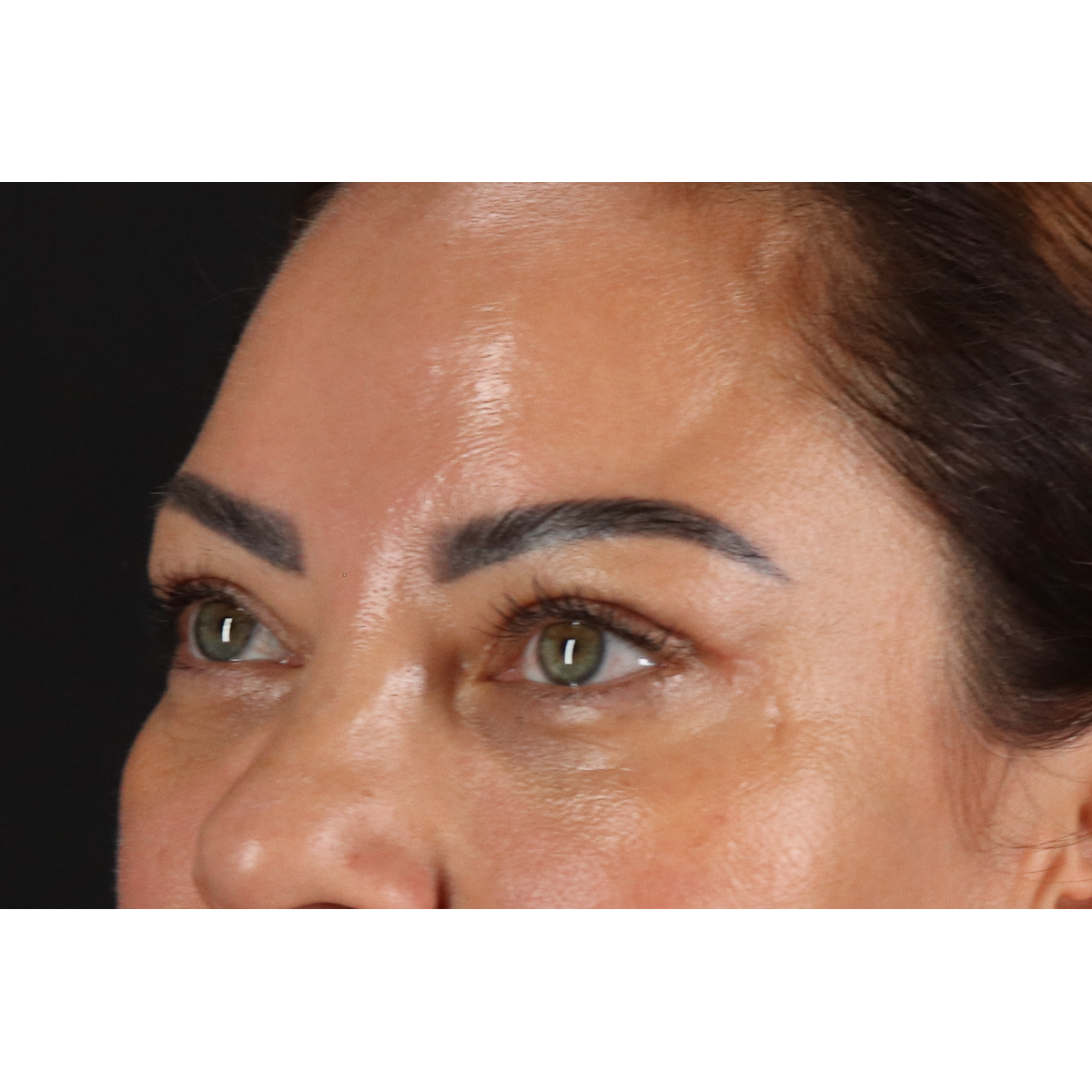 Eyelid Surgery Before & After Patient #3360