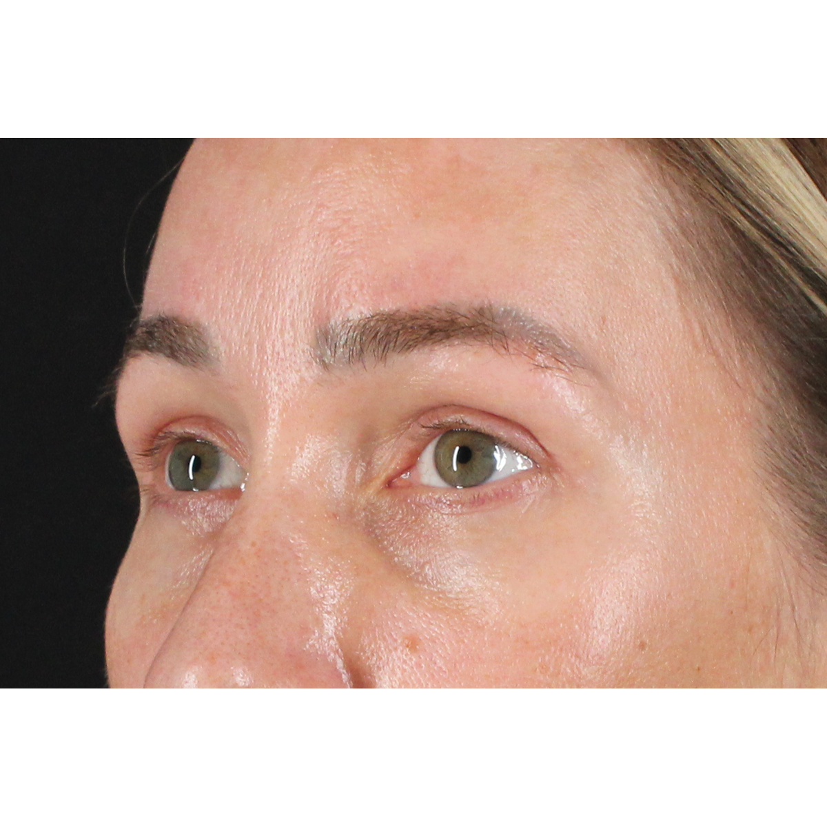 Eyelid Surgery Before & After Patient #3361