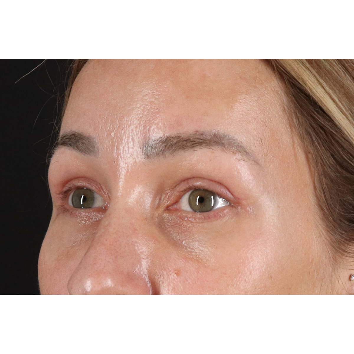 Eyelid Surgery Before & After Patient #3361