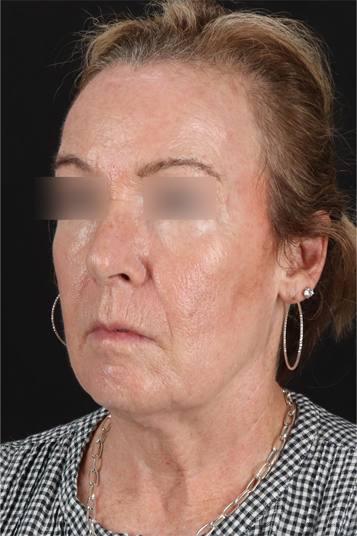 Laser Before & After Patient #3362