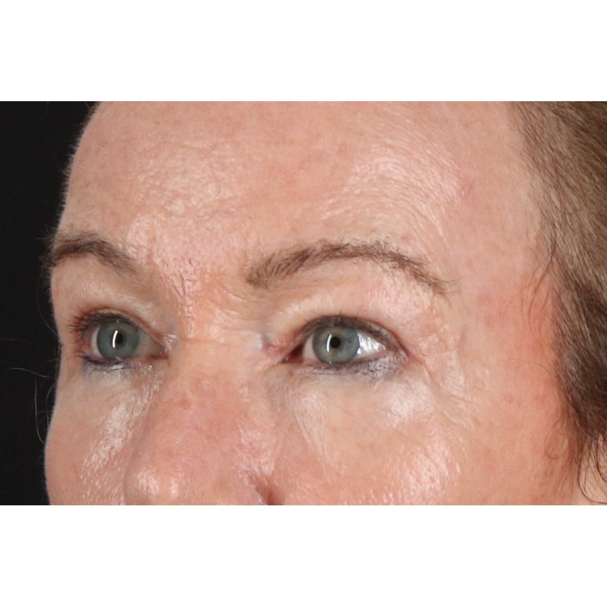 Eyelid Surgery Before & After Patient #3363