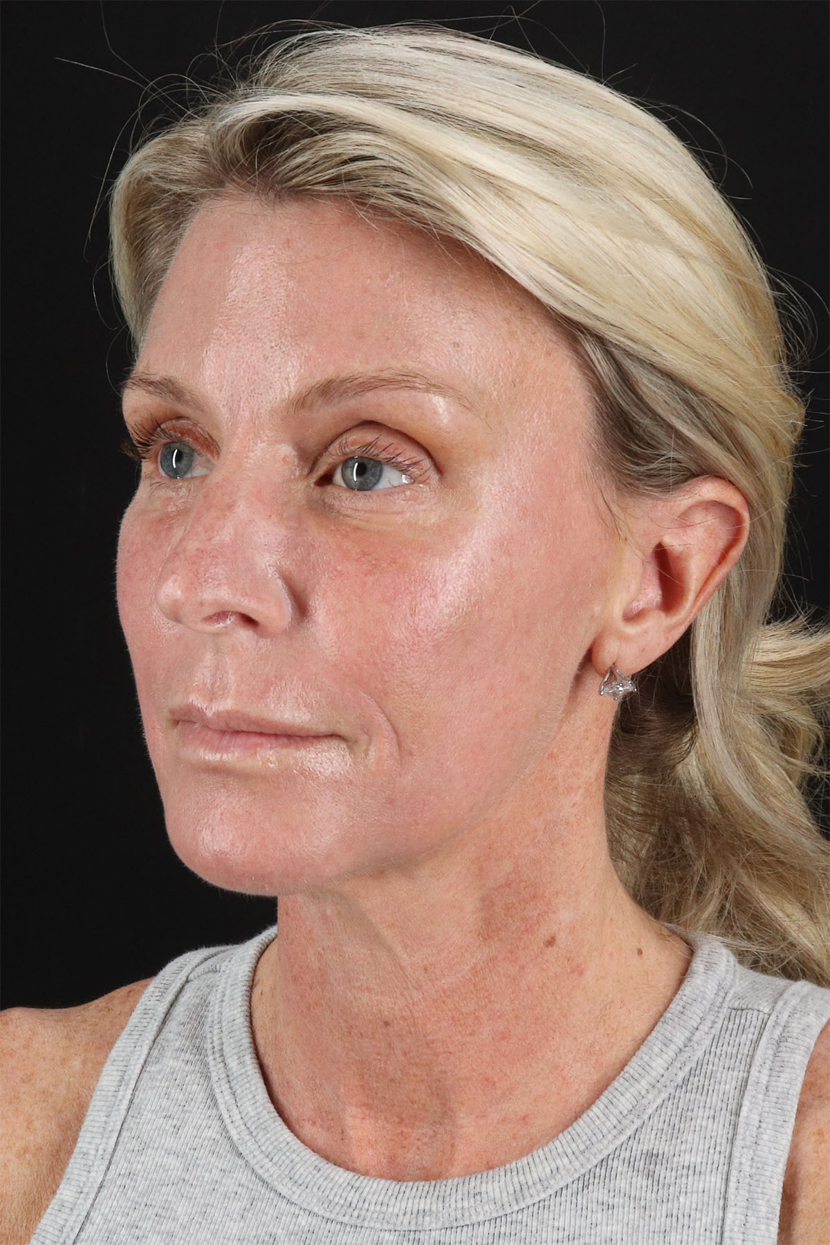 Ponytail Facelift Before & After Patient #3118