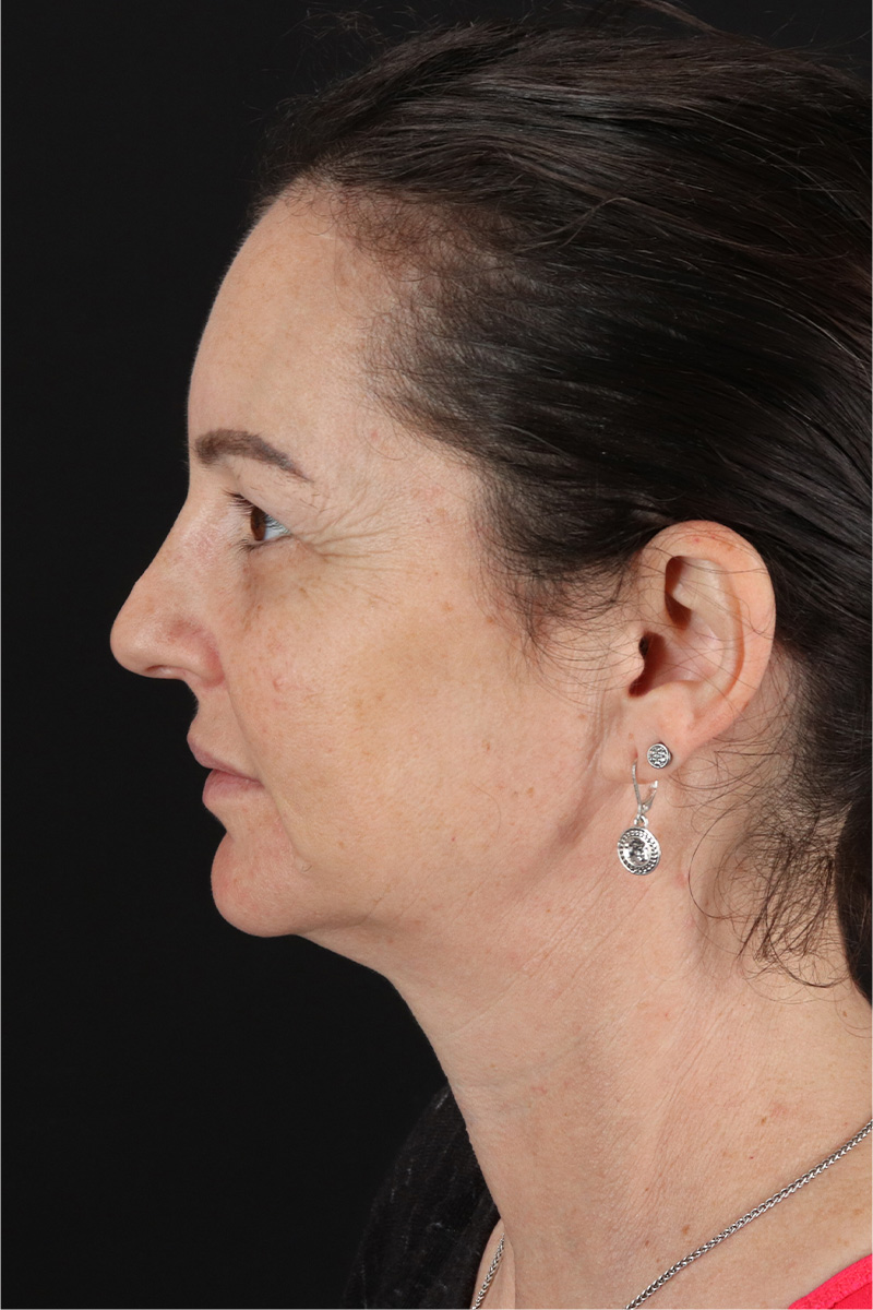 Chemical Peel Before & After Patient #3470