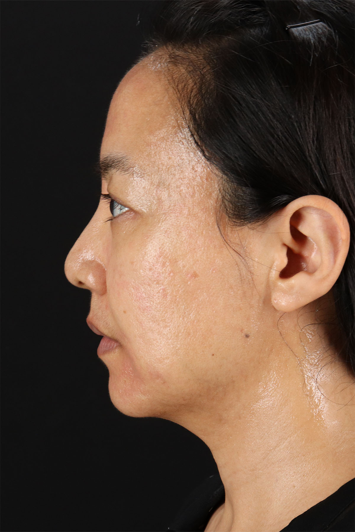 Skin Resurfacing / Laser Before & After Patient #3001
