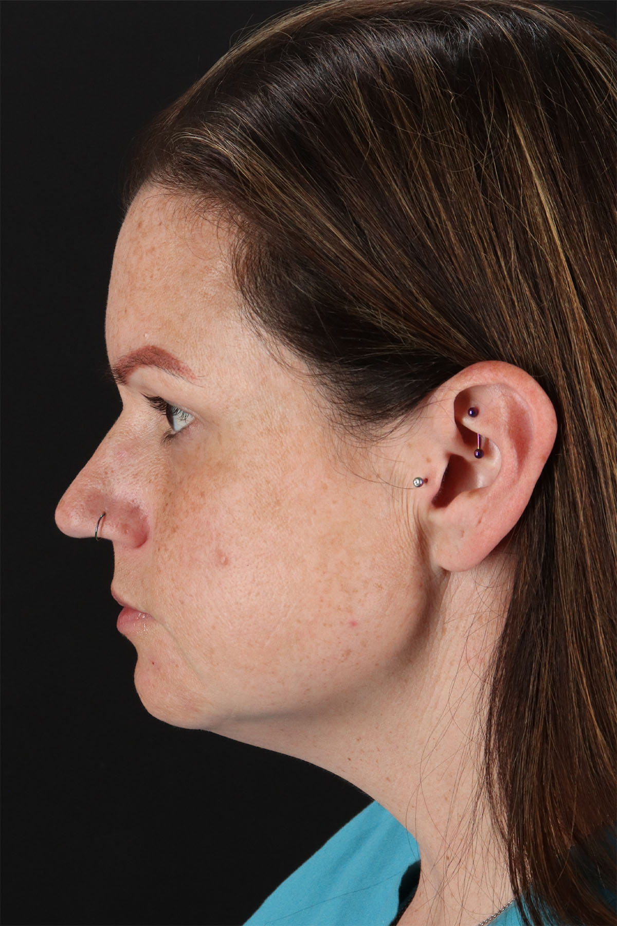 Chemical Peel Before & After Patient #3002