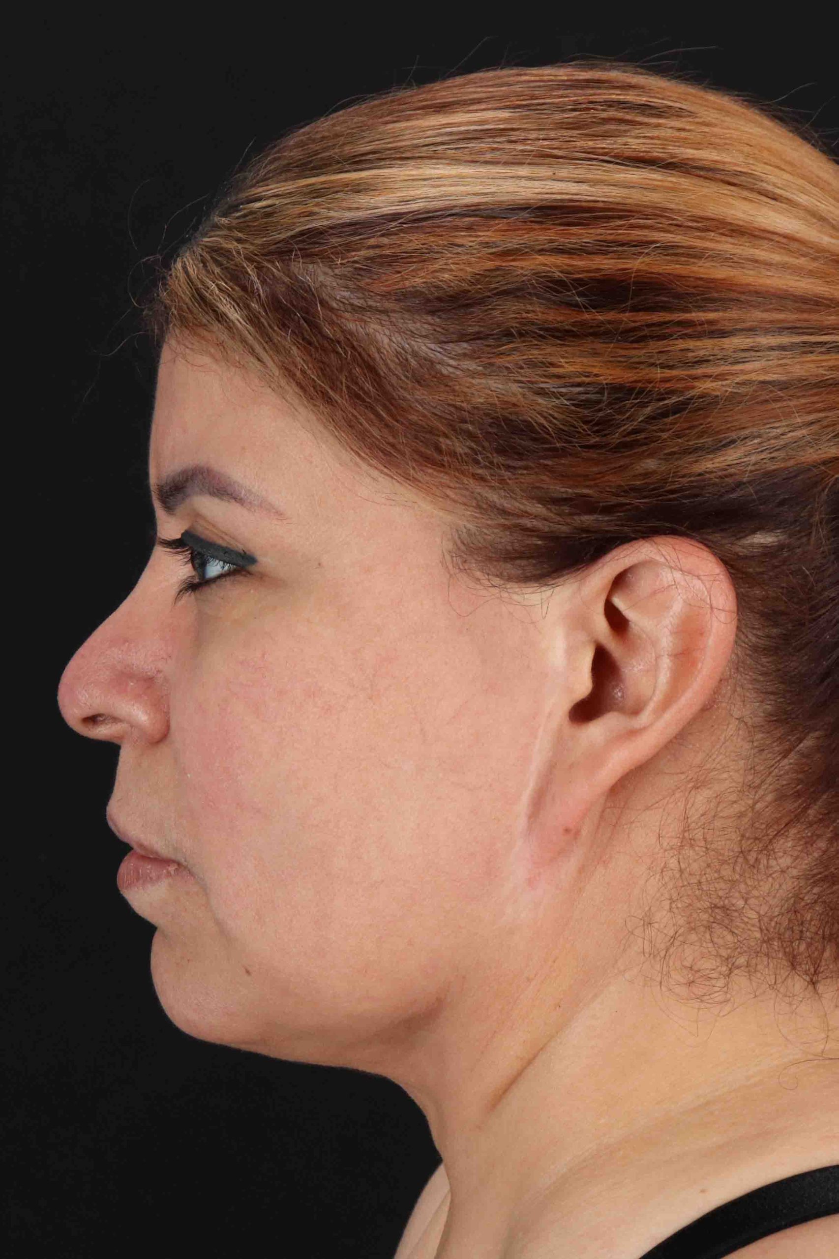 Structural Fat Grafting Before & After Patient #3642