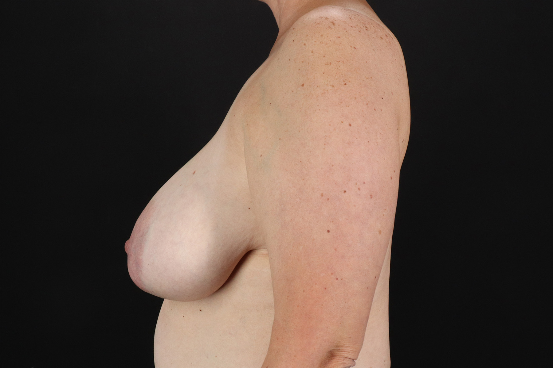 Breast Lift Before & After Patient #3004