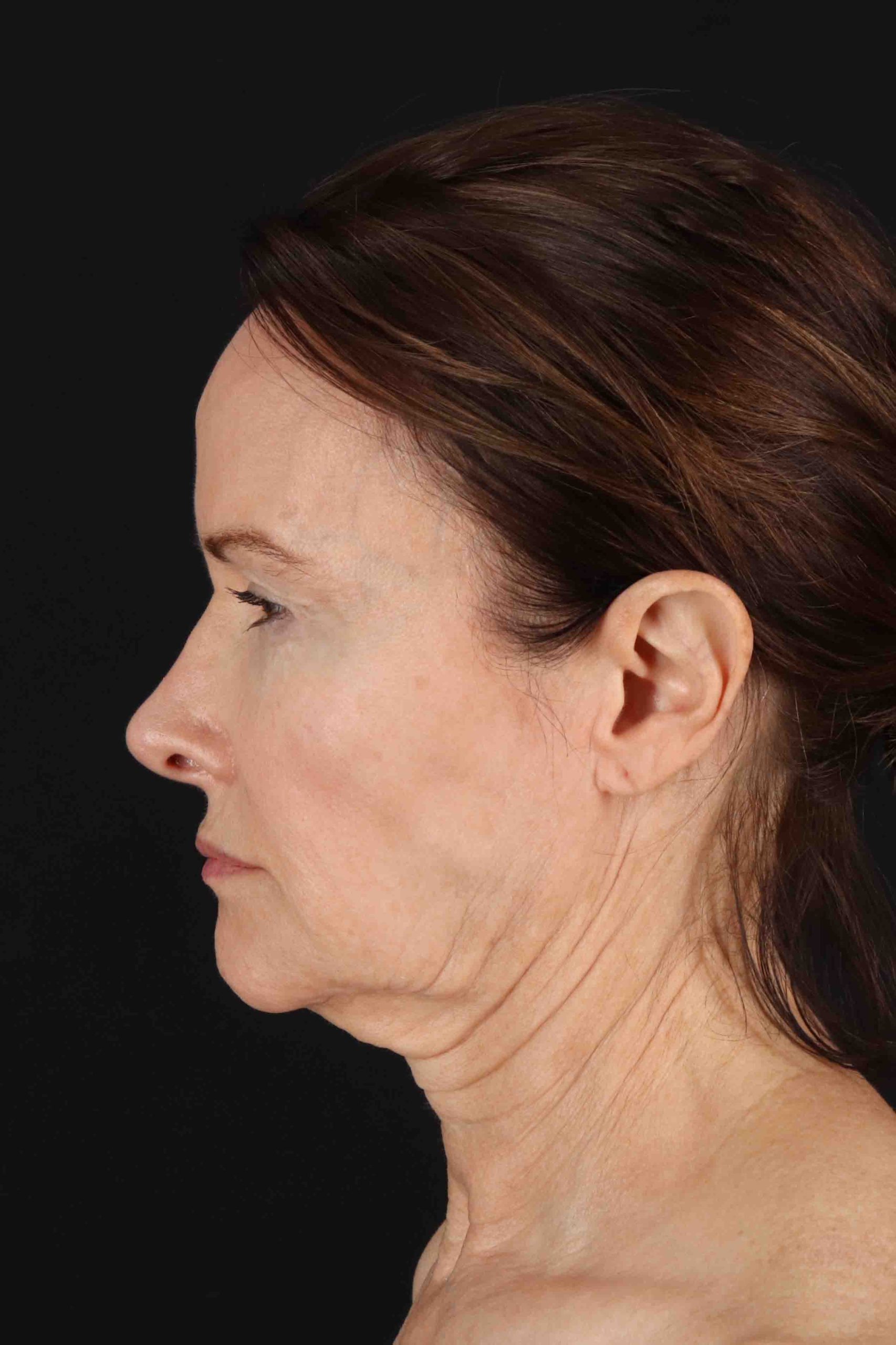 Structural Fat Grafting Before & After Patient #3643