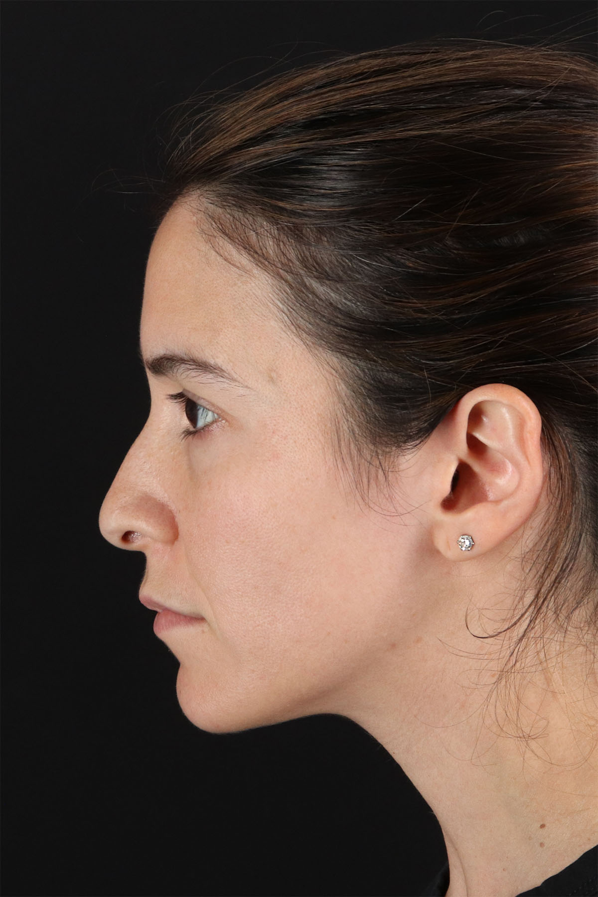 CO2 Laser Before & After Patient #3005