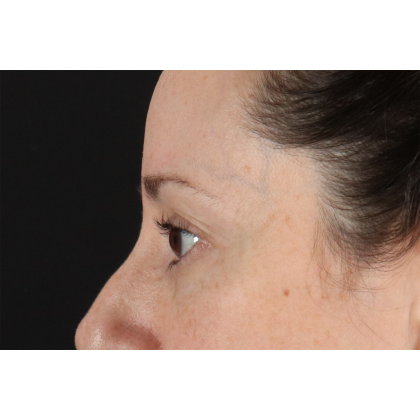 Eyelid Surgery Before & After Patient #3006