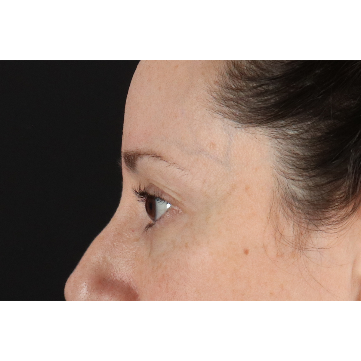Eyelid Surgery Before & After Patient #3006