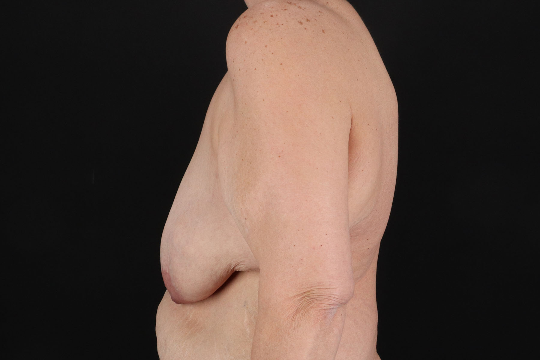 Breast Reduction with Lift Before & After Patient #3007