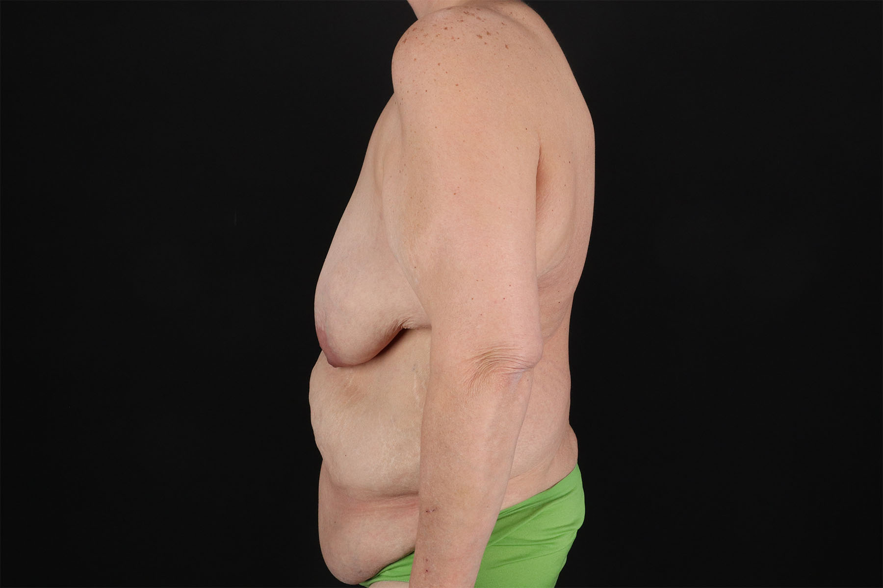 Breast Reduction with Lift Before & After Patient #3007