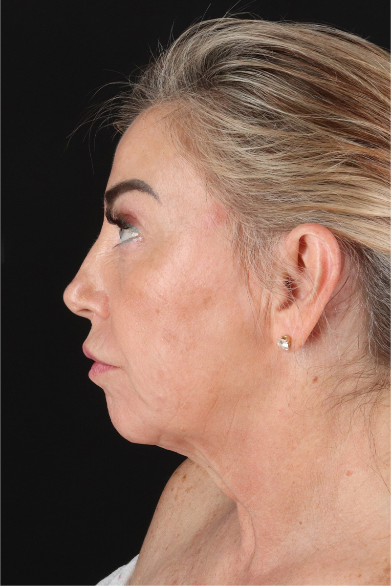 Neck Lift Before & After Patient #3476