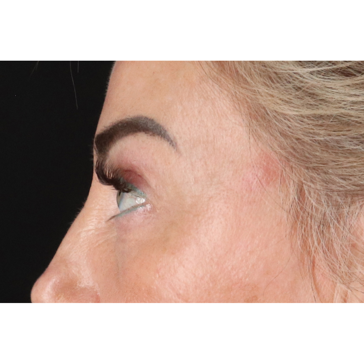 Eyelid Surgery Before & After Patient #3475