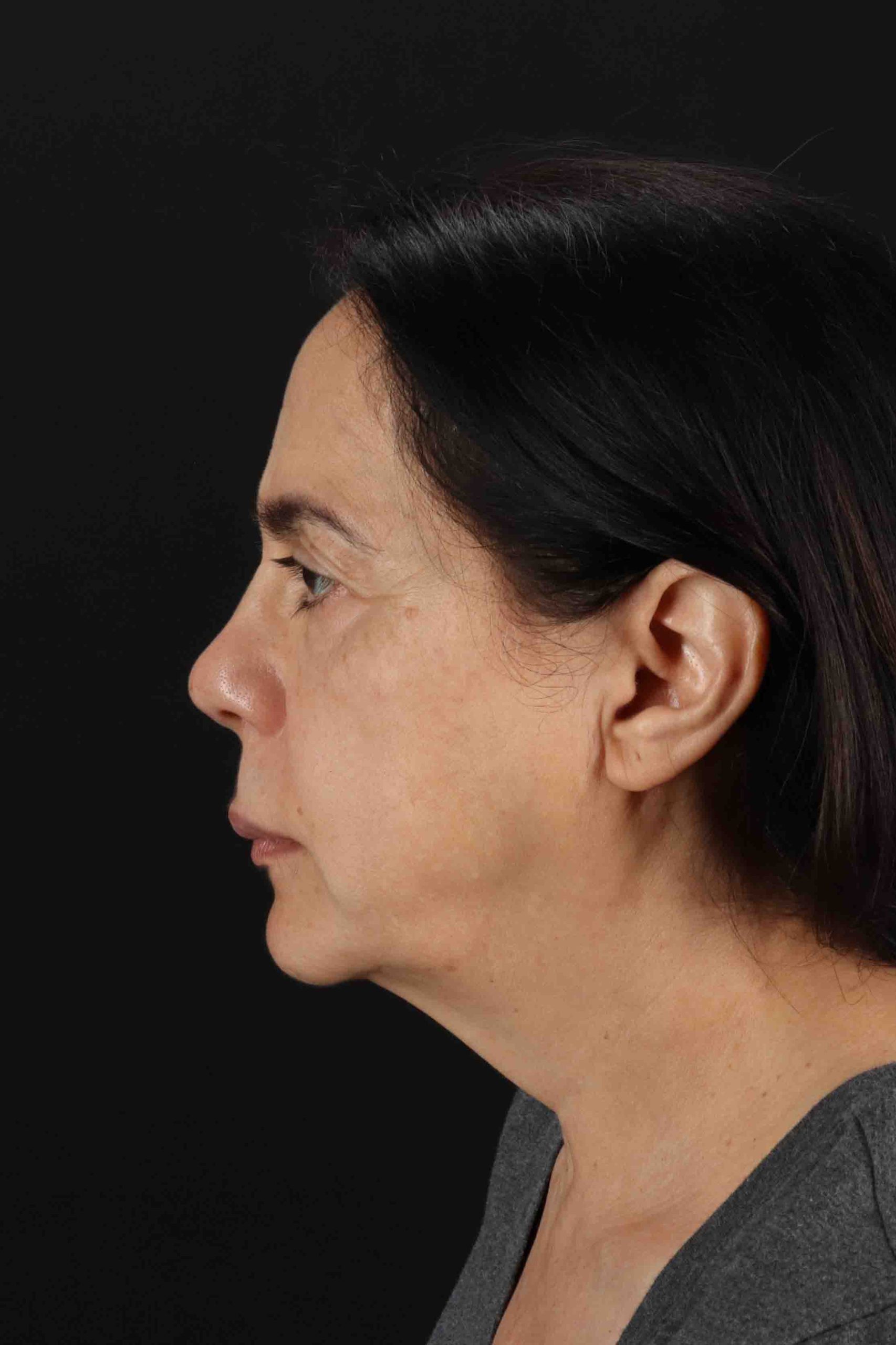 Structural Fat Grafting Before & After Patient #3645