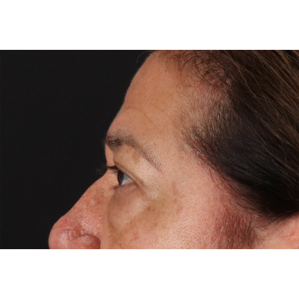 Eyelid Surgery Before & After Patient #3008
