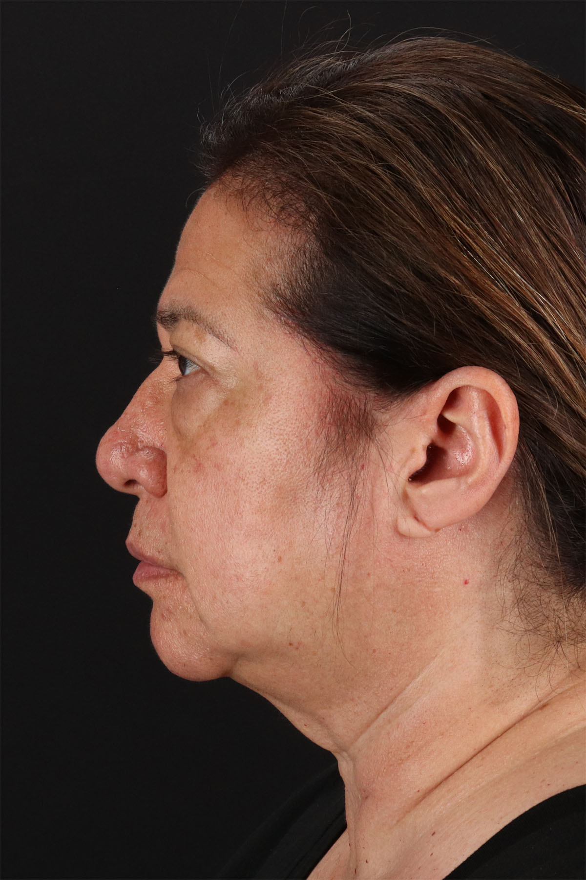 CO2 Laser Before & After Patient #3009
