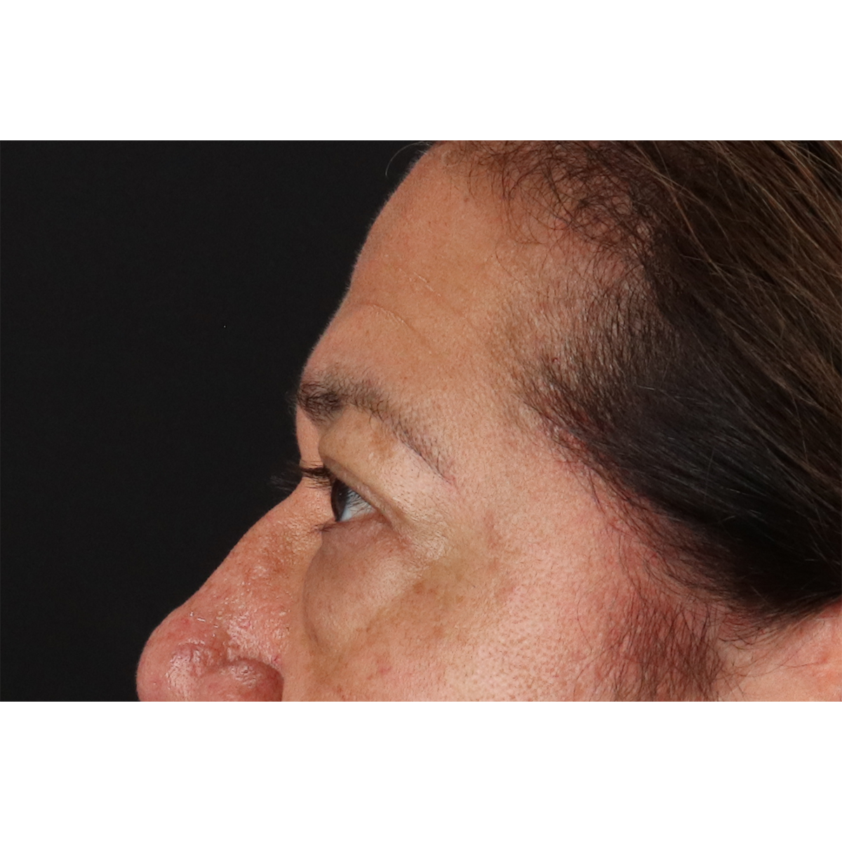 Eyelid Surgery Before & After Patient #3008