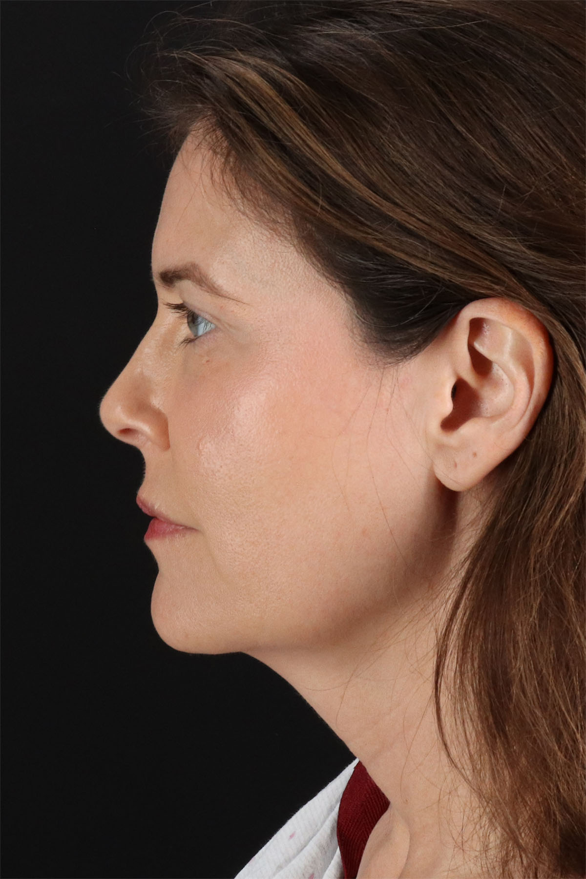 Structural Fat Grafting Before & After Patient #3647