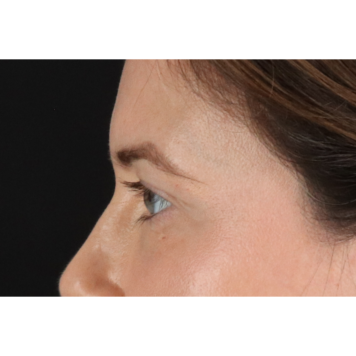 Eyelid Surgery Before & After Patient #3570