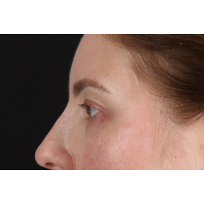 Brow Lift Before & After Patient #3111