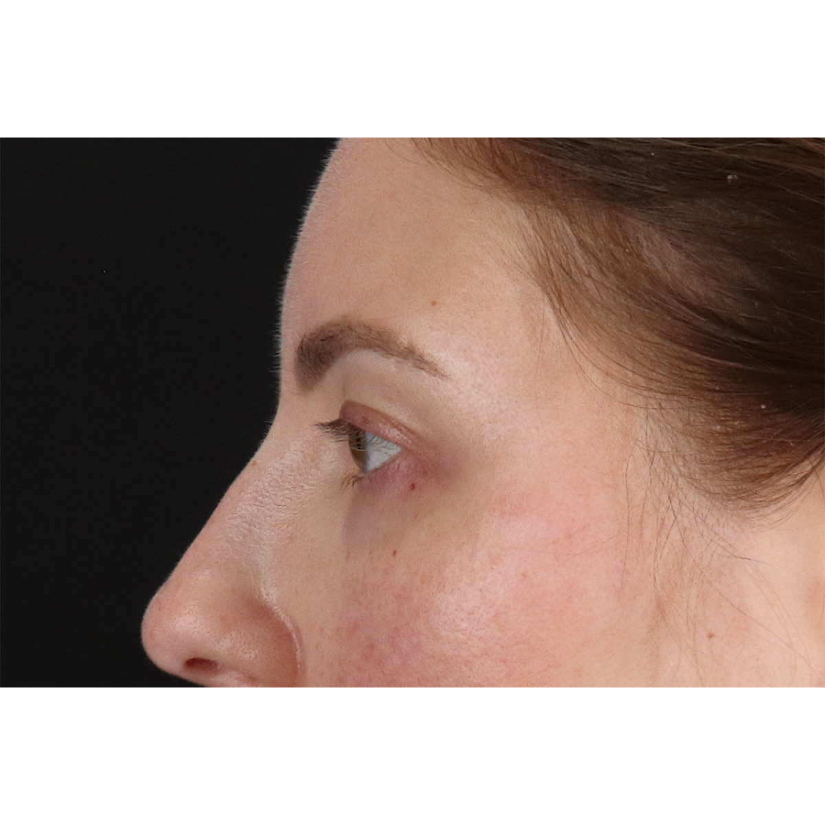 Brow Lift Before & After Patient #3111