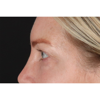 Eyelid Surgery Before & After Patient #3112