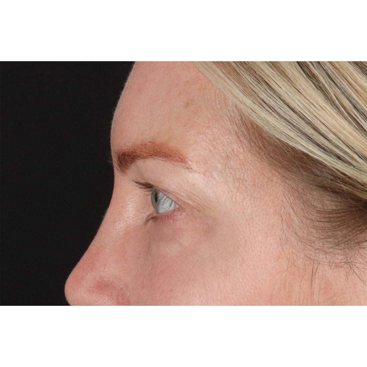Eyelid Surgery Before & After Patient #3112