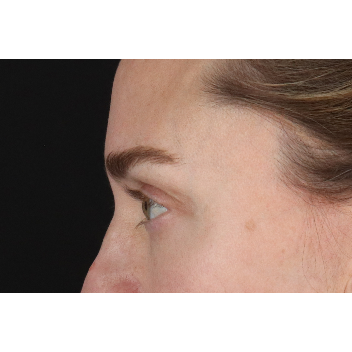 Eyelid Surgery Before & After Patient #3571