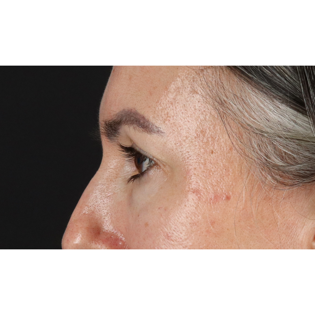 Eyelid Surgery Before & After Patient #3356