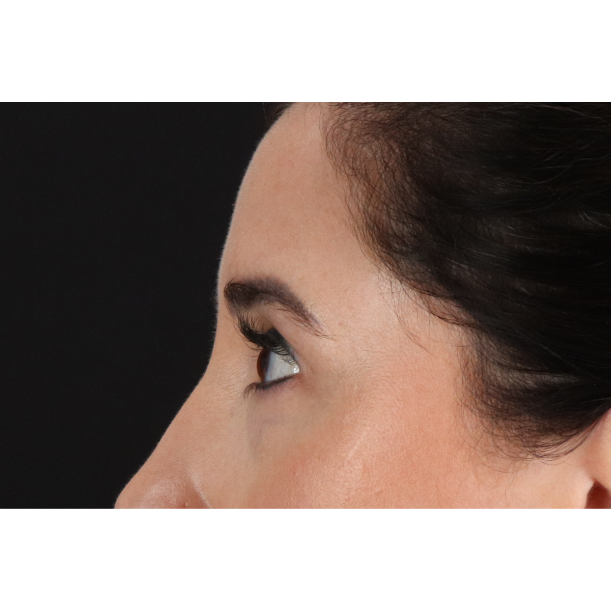 Eyelid Surgery Before & After Patient #3358