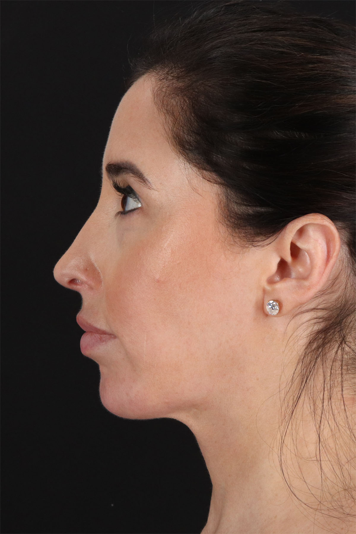 Structural Fat Grafting Before & After Patient #3649