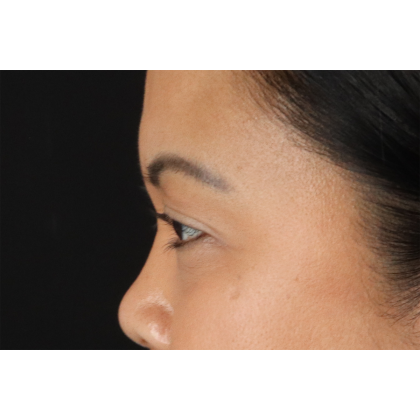 Brow Lift Before & After Patient #3114