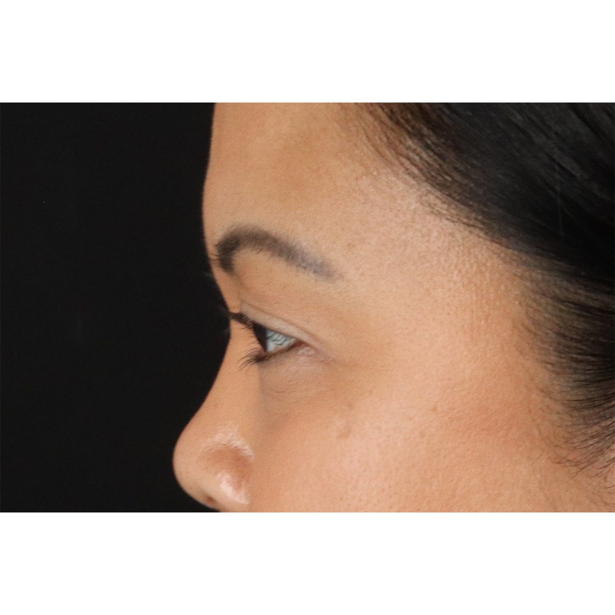 Brow Lift Before & After Patient #3114