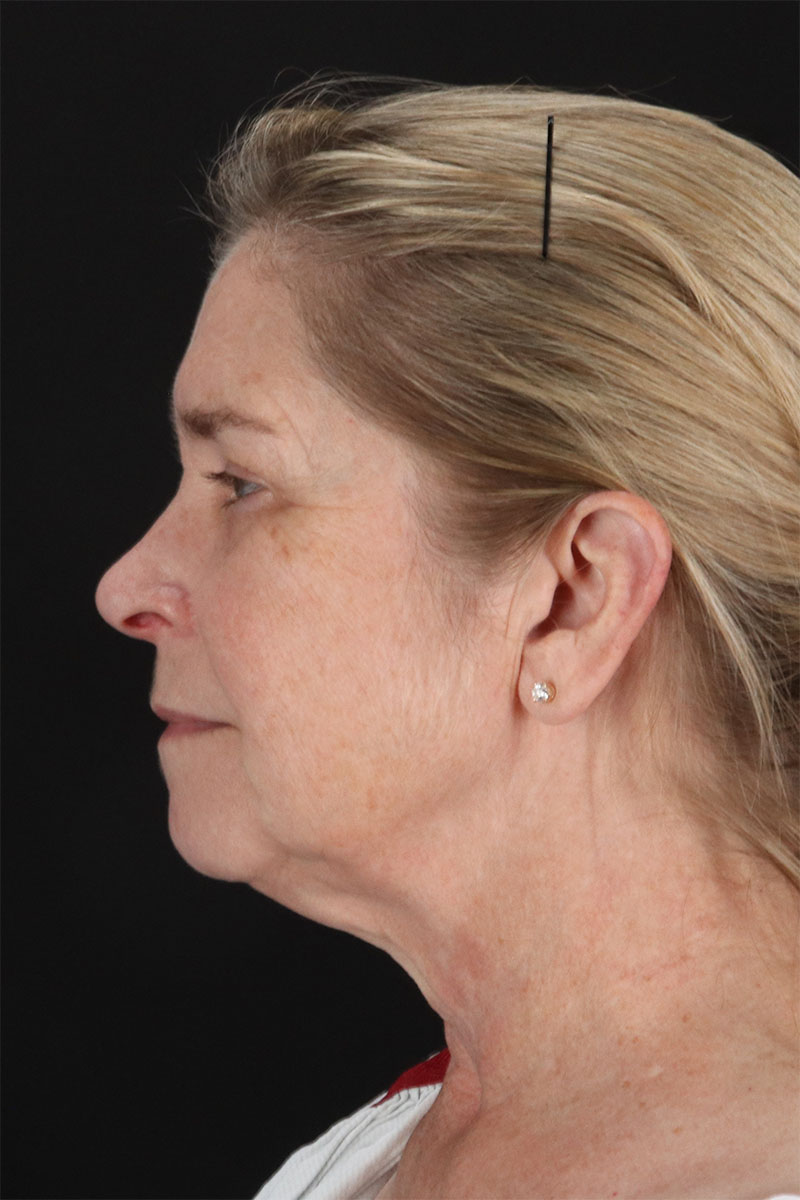 CO2 Laser Before & After Patient #3116