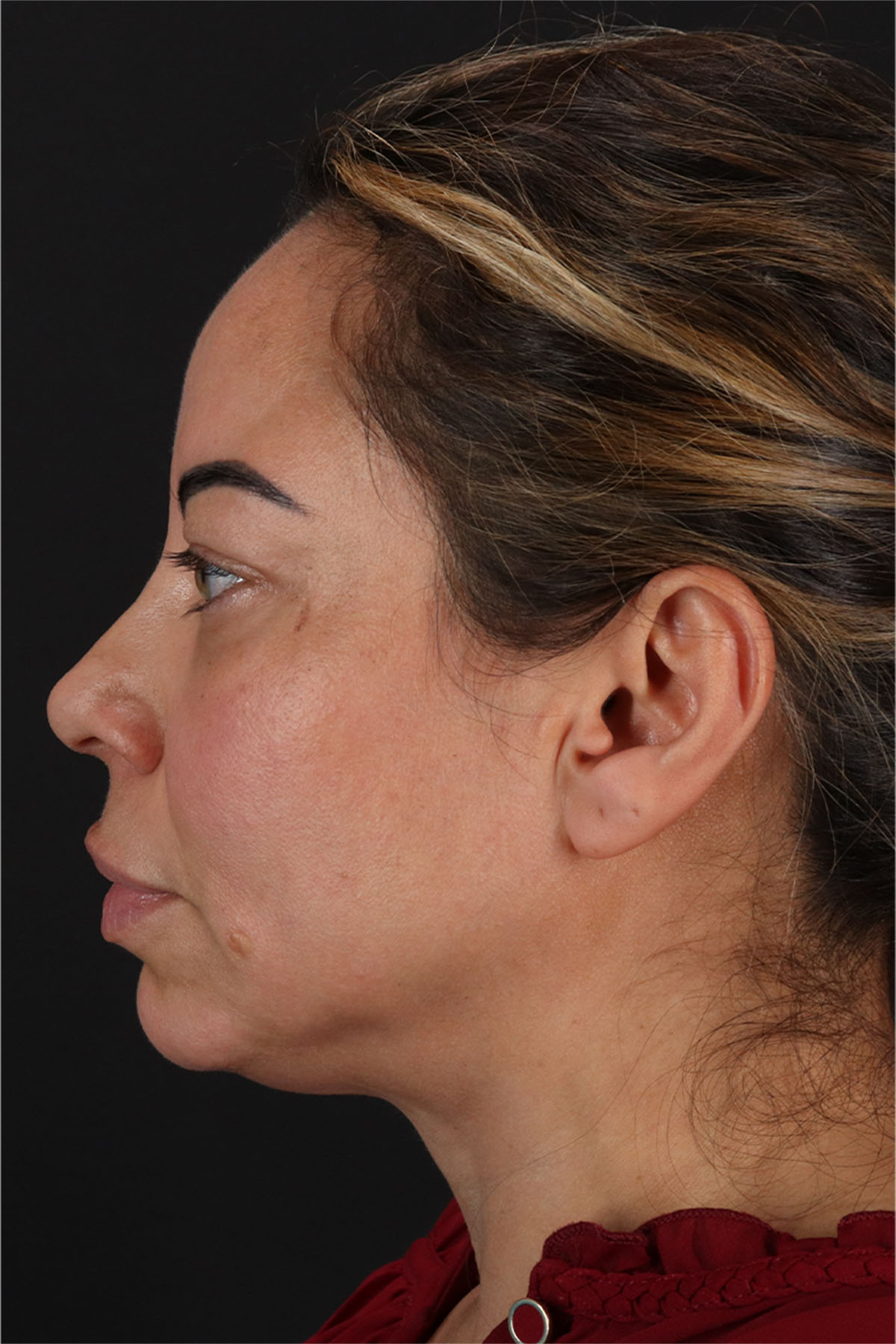 Laser Before & After Patient #3359
