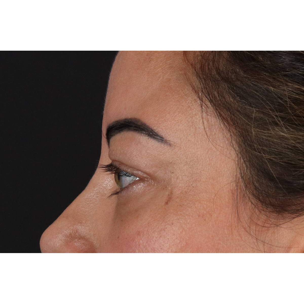 Eyelid Surgery Before & After Patient #3360