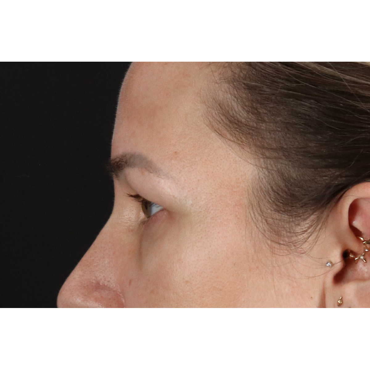 Eyelid Surgery Before & After Patient #3361