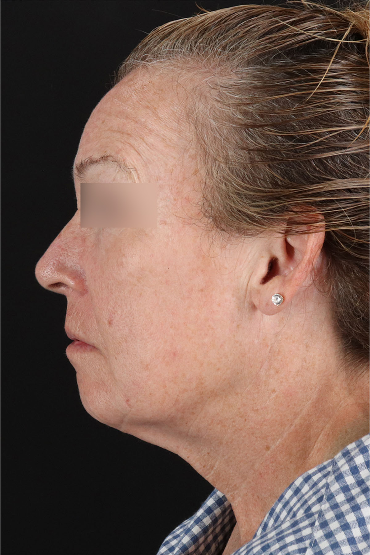 Laser Before & After Patient #3362