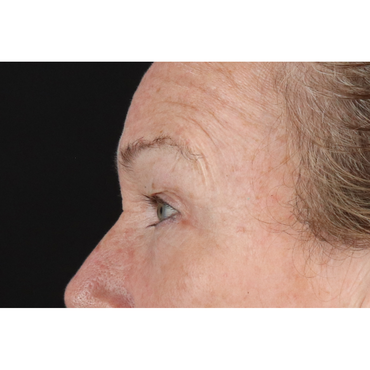 Eyelid Surgery Before & After Patient #3363