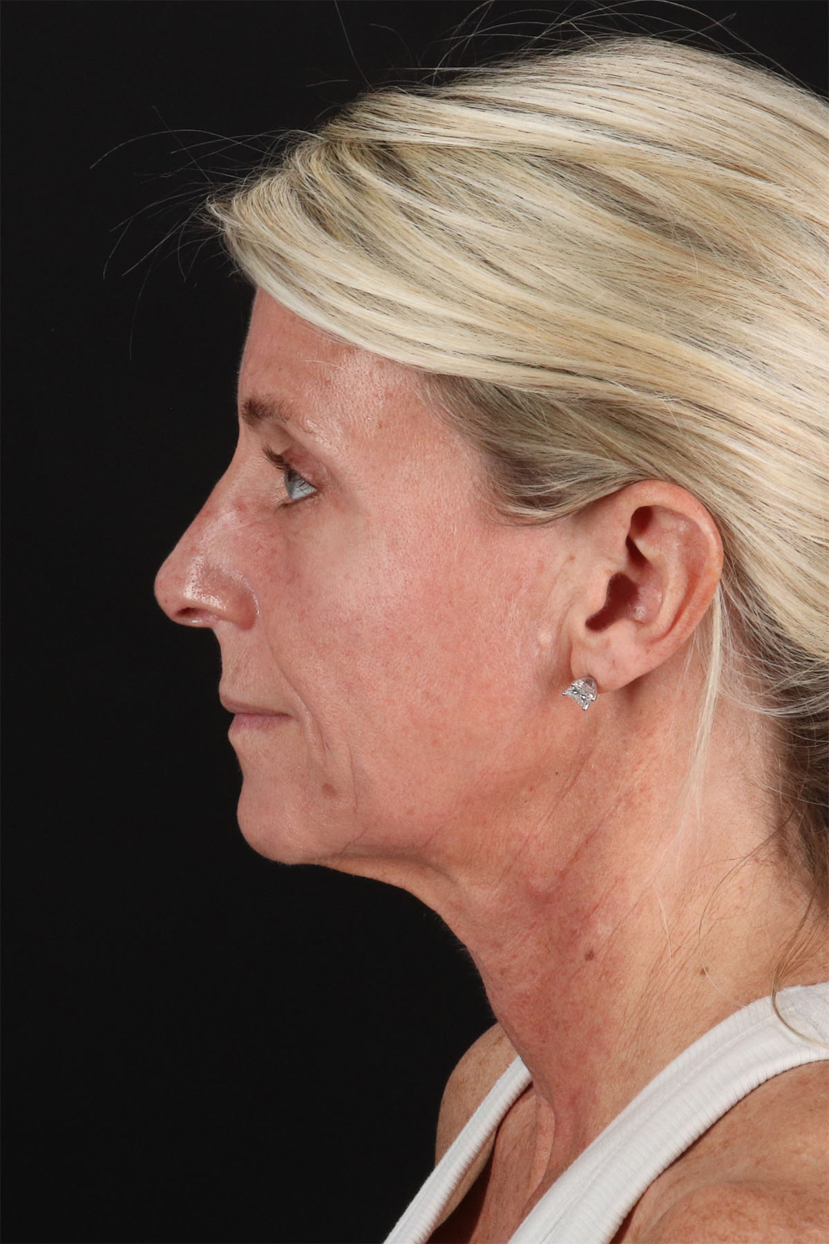 Ponytail Facelift Before & After Patient #3118